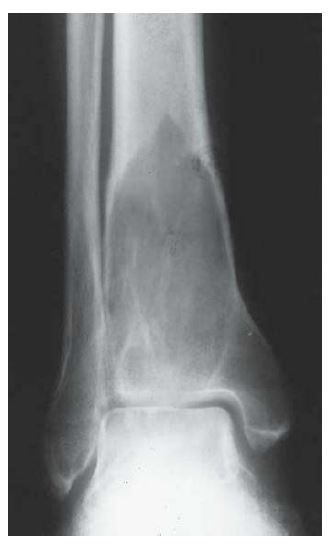 Paget Disease - acute phase of paget's displaying advancing subarticular osteolysis in the diaphyses of the tubular bones yielding a flame-shaped appearance Pagets Disease, I Healed, Knee Injury, Emergency Medical, Surgery, Disease, Ballet Shoes, Bones, Dance Shoes