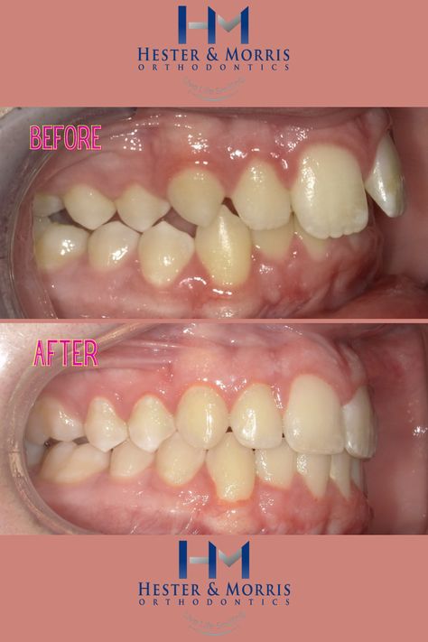 Amazing results from a real patients! Learn more about what we do! Braces Before And After, Straight Teeth, Clear Aligners, After Photos, Beautiful Smile, Braces