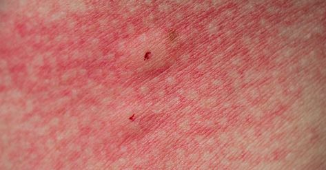 Treating Spider Bites, Spider Prevention, Spider Bites Pictures, Spider Identification, Home Remedies For Spiders, Spider Control, Spider Bite, Recluse Spider, Brown Recluse Spider