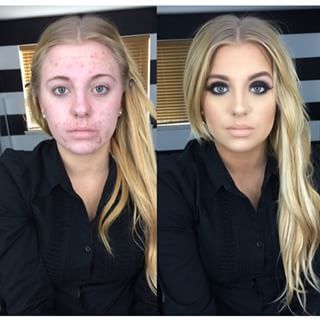 Last January, a friend of hers who runs a makeup Instagram account called @MakeupByDreigh posted this photo of VanPevenage. “I was having this allergic reaction to benzoyl,” VanPevenage told BuzzFeed News. “I knew I needed help to cover my acne.” | After  Discovering She Had Been Turned Into A Cruel Meme, This Woman Decided To Speak Out Before And After Acne, Bad Acne, Makeup Before And After, Power Of Makeup, Acne Breakout, The Beauty Department, Makeup Transformation, Diet Keto, Without Makeup