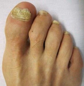 Fungal Nail Remedies Foot Fungus Remedies, Toenail Health, Toenail Fungal Infection, Nail Remedies, Nail Fungus Remedy, Fungal Nail, Ingrown Toe Nail, Toenail Fungus, Fungal Infection