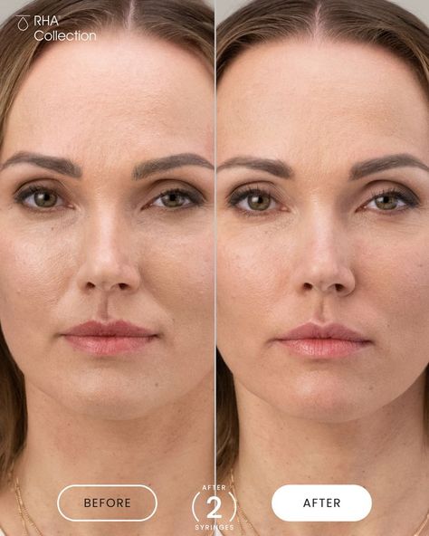 Designed to be more like the natural hyaluronic acid in your skin, the RHA® Collection is expertly made to adapt to dynamic facial expressions for a natural look. Specifically, RHA® 4 is made to add natural volume to dynamic wrinkles and folds. Do you notice the difference in Olena’s before and after photos? She was treated with a total of 2 syringes of RHA® 4 to bring natural volume to her smile and laugh lines. Swipe for Important Safety Information Dynamic Facial Expressions, Hyaluronic Acid Fillers, Facial Fillers, Laugh Lines, Smile Lines, Nasolabial Folds, Facial Wrinkles, Natural Structures, Face Exercises