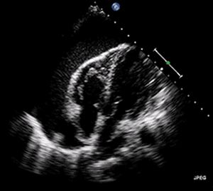 Pericardial Effusion, Nephrotic Syndrome, Heart Sounds, Heart Function, Low Blood Pressure, Viral Infection, Cleveland Clinic, Chest Pain, Cardiology