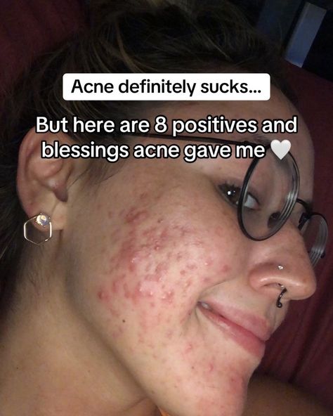 Thank you, acne 🤍. #adultacne #pcosacne #clearskin #glassskin #acnepositivity #acneneutrality What Does Acne On Your Chin Mean, Acne Supplements Clear Skin, How To Reduce Acne, Acne Confidence, Pretty People With Acne, Acne Pretty, Acne Is Normal, Acne Aesthetic, Girl With Acne