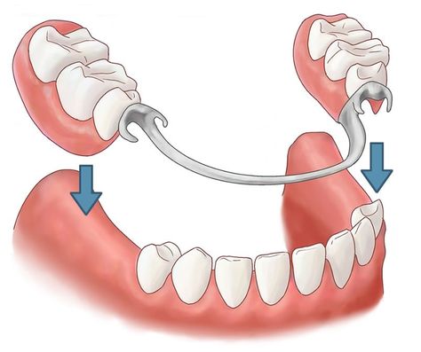 Prosthetic Device, Denture Adhesive, Tooth Repair, Dental Health Care, Dental Implants Cost, Partial Dentures, False Teeth, Tooth Replacement, Teeth Implants