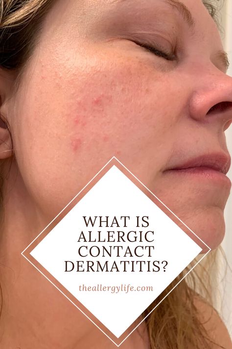 Allergic Reaction On Face Remedies, Face Allergy Remedies Skin Care, Allergic Reaction Rash Remedies, Contact Dermitis Face, Skin Allergy Pictures, Contact Dermitis Rash, Staphylococci Bacteria Infection On Skin, Atopic Dermitis Remedy, Allergic Reaction On Face