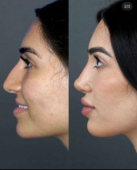 Natural Rhinoplasty Nose Jobs, Nose Job Transformation, Nose Job Bulbous Tip, Nose Job Front Profile, Straight Nose Aesthetic, Pretty Nose Front View, Nose Job Inspiration Natural, Nose Job Front View, Ethnic Nose Job