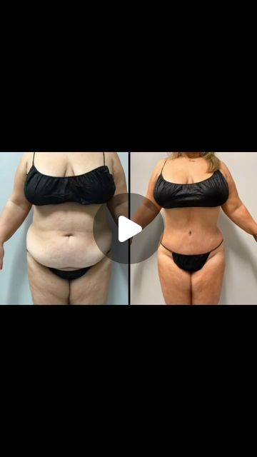 Dr. Yaqub Baraki on Instagram: "Lipo 360 with mini tummy tuck! Done awake with 5-7 day recovery" Lipo 360 Before And After, Skin Removal Surgery, Tummy Tucks Recovery, Mommy Makeover, Tummy Tucks, Skin, Instagram