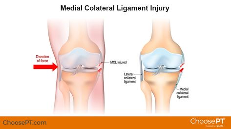 Kt Tape Knee Mcl, Mcl Strain Knee Exercises, Medial Collateral Ligament Exercises, Mcl Injury, Common Knee Injuries, Weight Lifting Equipment, Knee Strength, Sports Physical Therapy, Anterior Cruciate Ligament