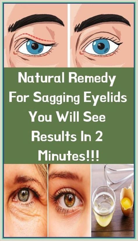 Natural Remedy for Sagging Eyelids-You Will See Results in 2 Minutes! Sagging Eyelids, Droopy Eyelids, Diy Remedies, Natural Therapy, Natural Diy, Natural Remedy, Natural Home Remedies, Natural Healing, Holistic Health