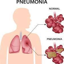 Natural Remedies For Pneumonia, Walking Pneumonia, Pencemaran Udara, Arterial Blood Gas, Natural Remedies For Migraines, Dry Skin Remedies, Sciatic Nerve Pain, Home Remedies For Hair, Natural Cold Remedies