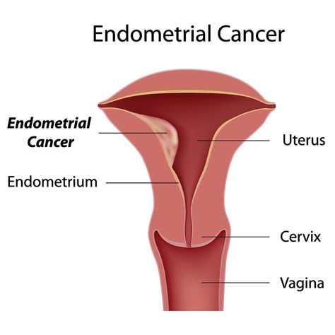 Endometrial Carcinoma, Female Reproductive System, Bone Loss, Reproductive System, Types Of Cancers, Storage Ideas, Womens Health, Kitchen Storage, Health