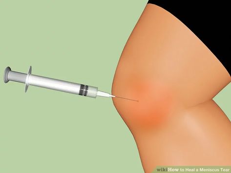 How to Heal a Meniscus Tear (with Pictures) - wikiHow Fitness Knee Meniscus, Knee Replacement Exercises, Knee Pain Relief Remedies, Patellofemoral Pain Syndrome, Knee Strength, Knee Pain Remedy, Swollen Knee, Ways To Heal, Knee Problem