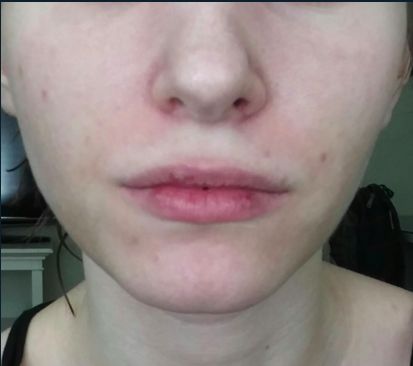 Permanent redness around mouth, sides of nose (10+ years) w/pics - Page 2 Redness Around Nose, W Pics, Marionette Lines, Keratosis Pilaris, Face And Body, Acne, Health, 10 Things, Red