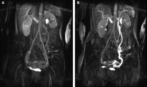 Nutcracker Syndrome: A Case Report – Consult QD Nutcracker Syndrome, Ultrasound Reveal, Superior Mesenteric Artery, Abdominal Aorta, Medicine Studies, Nuclear Medicine, Lower Abdomen, Cleveland Clinic, Patient Experience