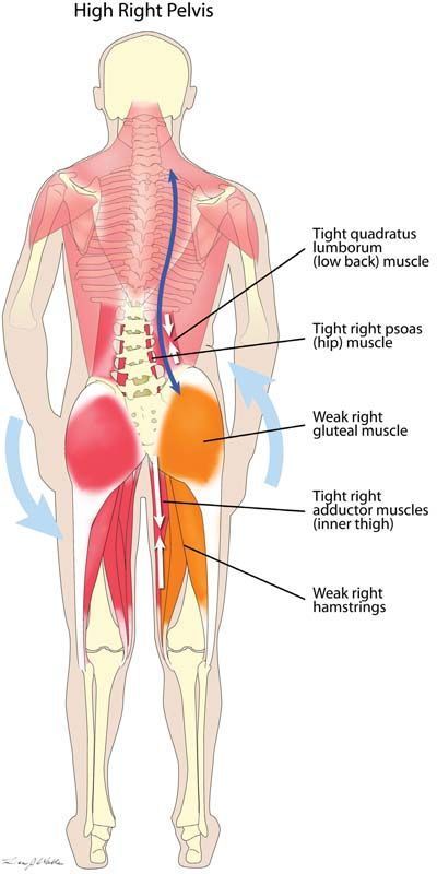 Misaligned Pelvis, Punkty Spustowe, Yoga Anatomy, Tight Hip Flexors, Muscle Imbalance, Muscle Anatomy, Hip Muscles, Tight Hips, Hip Flexor