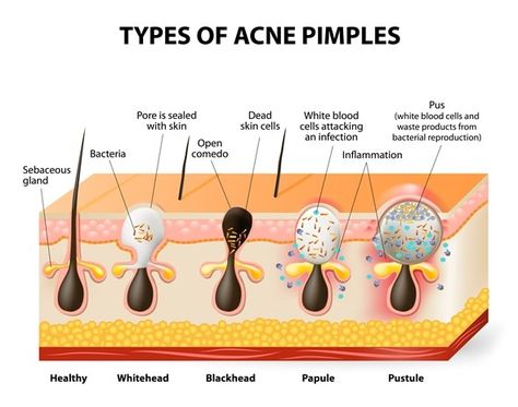 Nodular Acne, Different Types Of Acne, Skin Anatomy, Skin Facts, Acne Vulgaris, Types Of Acne, Acne Causes, Hormonal Acne, Acne Solutions