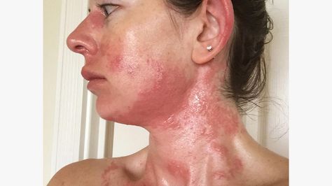 Shingles Symptoms Signs, Shingles On Face, What Causes Shingles, Shingles Symptoms, Shingles Remedies, Treating Shingles, Shingles Relief, Shingles Rash, Rash On Neck