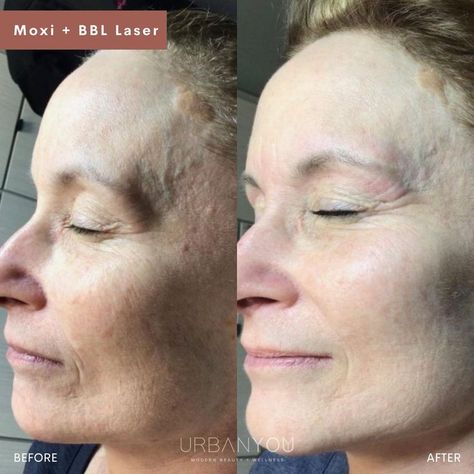 Moxi + BBL Laser | Before and After Eliminate Wrinkles, Medical Spa, West Michigan, A Fresh Start, Laser Lights, Younger Looking Skin, Beauty Wellness, Fresh Start, Skin Rejuvenation