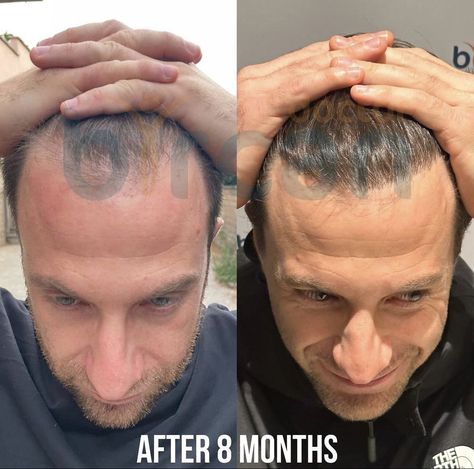 ‼Operation method : Fue Graft number : 3250 Donor zone quality: 100% Transplanted area: hairline For more detail information visit our website : www.doctorbircan.com WhatsApp /Telegram /Viber /İmo +90 537 520 0078 🇷🇺🏴󠁧󠁢󠁥󠁮󠁧󠁿 +90 538 013 41 37 🇷🇺 🇺🇦 +90 (531) 696 79 40 🇪🇸🇧🇷 +90 536 351 2900🇮🇹 Hair Transplant Procedure, Self Esteem Issues, Good Doctor, Self Conscious, Hair Transplant, Before And After Pictures, Pain Free, Easy Hairstyles, Istanbul