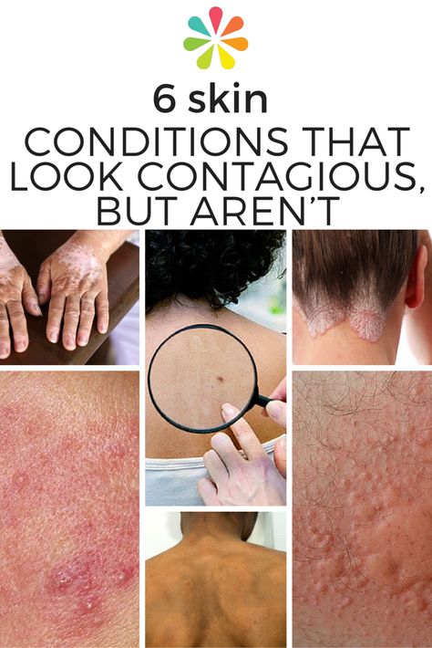 In reality, many of the most common skin conditions aren’t the least bit contagious. #skinhealth #contagiousconditions #stayhealthy #everydayhealth | everydayhealth.com Skin Rash On Face, Skin Conditions Pictures, Skin Rash Remedies, Skin Rashes Pictures, Project Notebook, Skin Anatomy, Health Chart, Fractional Laser, Skin Facts