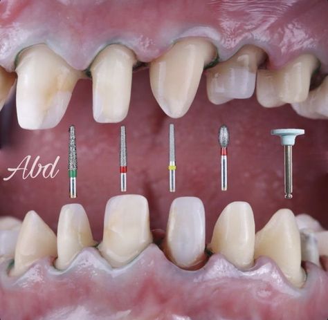 Prosthodontics Dentistry, Dental Burs, Dental Assistant Study, Dental Hygiene Student, Dental Doctor, Dental World, Dental Aesthetics, Dental Videos, Kesehatan Gigi