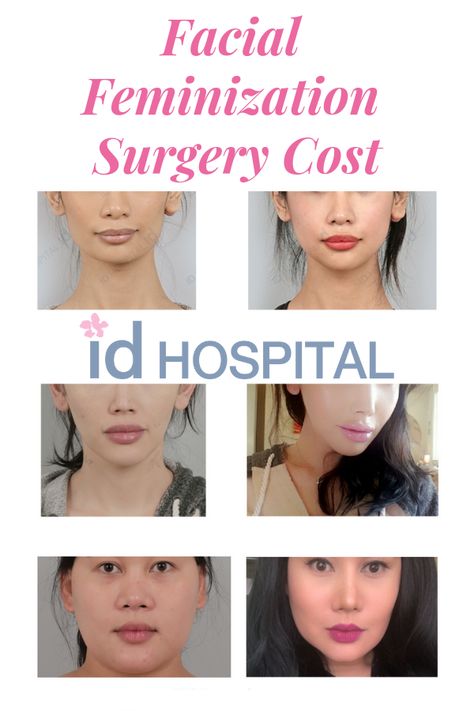 Planning to get FFS in Korea? Here is a price guide to help you plan your surgery with ease. #idhospital #idhospitalkorea #plasticsurgery #koreanplasticsurgery #surgeryinkorea #ffs #facialfeminizationsurgery #ffsbeforeandafter #ffscost #ffskorea Feminine Facial Surgery, Ffs Surgery Before And After, Ffs Surgery, Korean Plastic Surgery, Facial Surgery, Female Transformation, Thigh Tattoos Women, Price Guide, Cosmetic Surgery