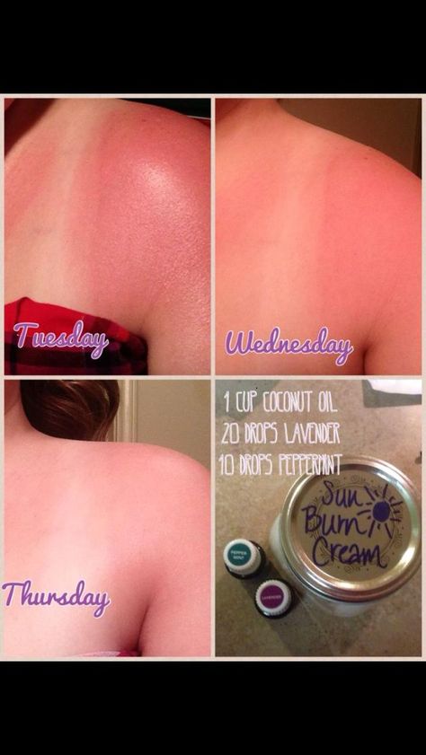 Sunburn Cream, Essential Oil For Sunburn, Natural Wart Remedies, Natural Remedies For Sunburn, Sunburn Remedies, Skin Cream Anti Aging, Sunburn Relief, Yl Oils, Sun Burn