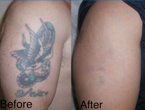 Tattoo removal- actual client - before and after Tattoo Redo Before And After, Tattoo Removal Before And After, Laser Tattoo Removal Before And After, Lazer Removed Tattoo Before And After, Tattoo Coverups, Tattoo Removal Laser, Natural Tattoo Removal, Tattoo Removal Cream, Tattoo Removal