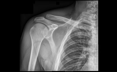 shoulder xray Shoulder Dislocation, Anatomy Study, Nursing Education, Radiology, Deep Learning, X Ray, Machine Learning, Google Images, Bones