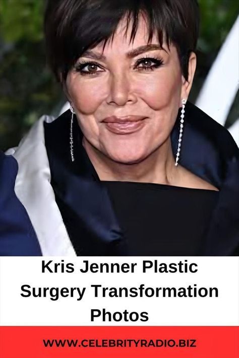 Kris Jenner Plastic Surgery, Bad Celebrity Plastic Surgery, Positivity Tattoo, Celebrity Surgery, Bad Plastic Surgeries, Plastic Surgery Fail, Plastic Surgery Photos, Hairstyles For Gowns, Plastic Surgery Gone Wrong