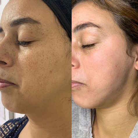 Result Treatment For Pigmentation Sunspots After A Month Skin Facts, Open Pores, Before After, Basic Skin Care Routine, Facial Exercises, Beauty Center, Skin Blemishes, Instagram My Story, Youthful Skin