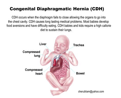 CDH Awareness Cdh Awareness, My Miracle, High Risk Pregnancy, Big Chill, Unborn Baby, I Love My Son, Medical Problems, So Thankful, Cavities