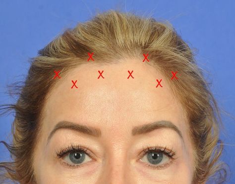 Botox Forehead Injection Sites, Botox Face Mapping, Botox Brow Lift Before And After, Botox Placement, Botox Mapping, Botox Forehead, Botox Injection Sites, Botox Training, Botox Brow Lift