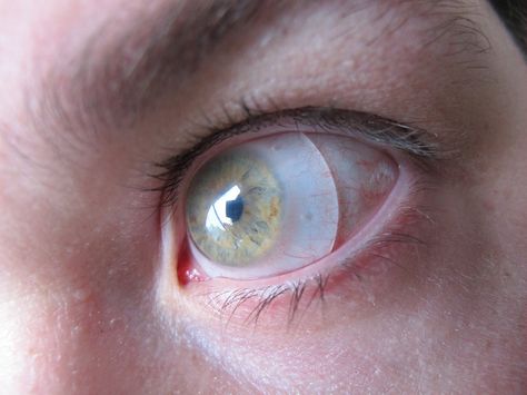 Image showing an eye with scleral lens Corneal Transplant, Eye Parts, Look Into My Eyes, Eye Health, Contact Lenses, Things To Know, Lenses