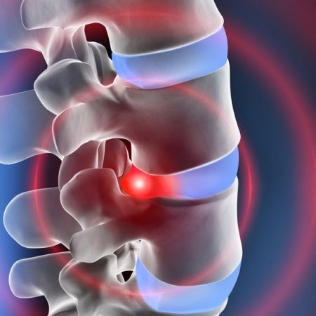 4 Classic Symptoms Of Bulging Disc In Neck Bulging Disc In Neck, Bulging Disc Exercises, Cervical Disc, Cold Laser Therapy, Intervertebral Disc, Neck Problems, Bulging Disc, Lower Back Pain Exercises, Run Through