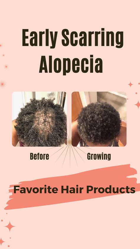 Natural Hair 4c Hairstyles, Alopecia Hairstyles Black Women, Hairstyles 4c Natural Hair, Hair Care 4c, Natural Hairstyles 4c, 4c Natural Hairstyles, Natural Hair 4c, Scarring Alopecia, Alopecia Hair Growth