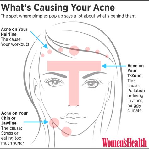 You Can Tell What's Causing Your Acne By Where You Break Out | Women's Health Magazine Korean Beauty Secrets, Prevent Pimples, Natural Acne Remedies, Acne Causes, Acne Scar Removal, Hormonal Acne, Cystic Acne, Acne Remedies, How To Get Rid Of Acne