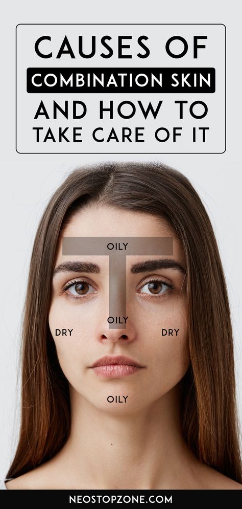 Dry combination skin is characterized by dry cheeks and an oily T-zone. Most of your sebaceous glands are positioned in your T-zone. This primarily means your T-zone produces extra sebum than the rest of your face. When your skin is dry, the sebaceous glands might overproduce oil to keep it hydrated, which will end in a greasy, oily forehead and nose bridge. Nonetheless, your cheeks might stay dry. #skin #skincare #combinationskin