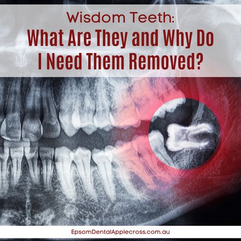 Wisdom teeth, or third molars, emerge between 17 and 25. Some people have two or four, while few have no wisdom teeth. Extraction is often recommended, but only if the teeth cause problems. Wisdom teeth are the final four to appear, often causing insufficient jaw bone space and difficulty cleaning. #ImpactedWisdomTeeth #DentalExtractionAdvice #ExpertDentalCare #DentistApplecross #ApplecrossDentalClinic Wisdom Teeth Extraction, Impacted Wisdom Teeth, Teeth Extraction, Dental Health Week, Early Adulthood, Dental Extraction, Wisdom Tooth Extraction, Wisdom Tooth, Gum Inflammation