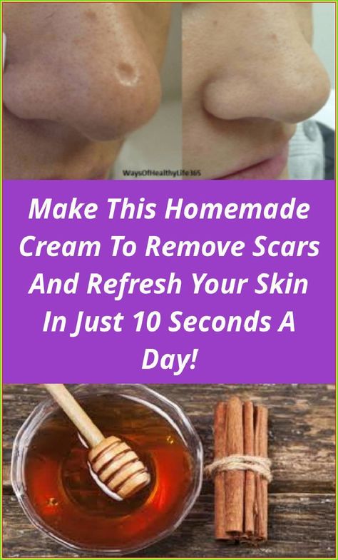 Click on the link to learn more Make This Homemade Cream To Remove Scars And Refresh Your Skin In Just 10 Seconds A Day! Check the webpage to read more. Honey Wrap, Lighten Hair, Scar Cream, How To Lighten Hair, Vicks Vaporub, Scar Removal, Unwanted Hair Removal, Healthy Lifestyle Tips, 10 Seconds