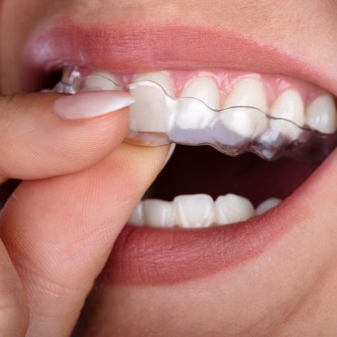 Invisalign Aligners, Teeth Alignment, Remedies For Tooth Ache, Traditional Braces, Invisible Braces, Clear Braces, Clear Aligners, Teeth Straightening, Metal Braces