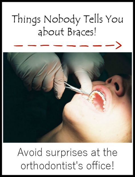 Things nobody tells you about braces | OurFamilyWorld.com Invisible Teeth Braces, Braces Food, Orthodontist Office, Braces Cost, Adult Braces, Braces Tips, Getting Braces, Invisible Braces, Teeth Whitening Diy