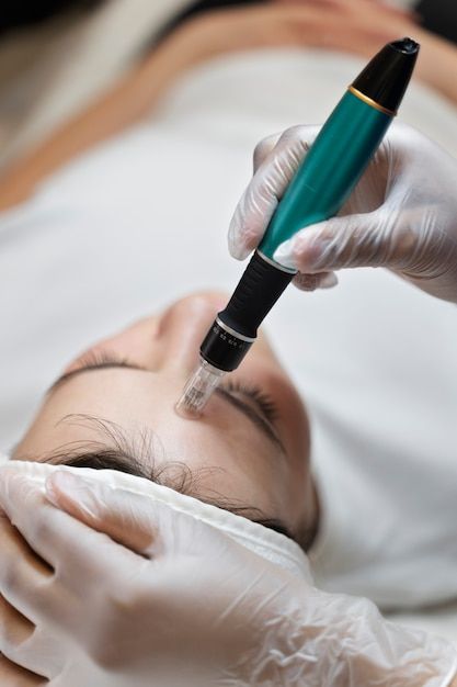 Free photo person getting micro needling... | Free Photo #Freepik #freephoto #microneedling #collagen #cosmetics-collagen #cosmetics-beauty Microneedling Video, Micronidelling Face, Microneedling Aesthetic, Esthetics Photos, Dermapen Microneedling, Facial Pictures, Remove Skin Tags Naturally, Skin Needling, Micro Needling