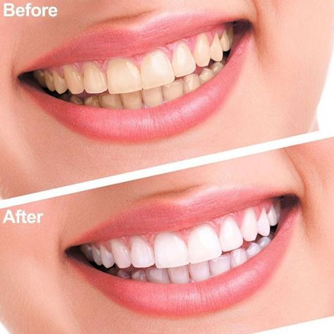 Dental Bleaching, Best Teeth Whitening Kit, Teeth Whitening Homemade, Teeth Whitening Remedies, Teeth Whitening Toothpaste, Laser Teeth Whitening, Charcoal Teeth Whitening, Teeth Bleaching, Teeth Whitening Pen