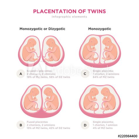 Stock Image: Twin types infographic elements in flat design. Monozygotic or Dizygotic Placentation of twins medical illustration and icons isolated on white background. Types Of Twins, Third Month Of Pregnancy, Nursing Instructor, Midwifery Student, Infographic Elements, Nursing School Survival, Fetal Development, Obstetrics And Gynaecology, Medical Terminology