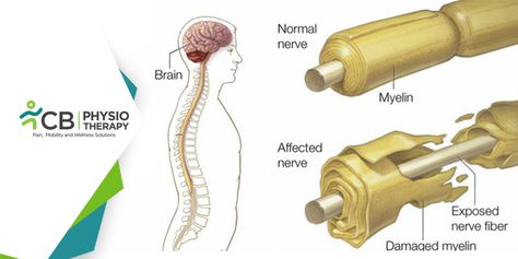 Guillain-Barré Syndrome Guillain Barre, Chest Infection, Guillain Barre Syndrome, Peripheral Nervous System, Rare Disorders, Nerve Fiber, Peripheral Nerve, Muscle Weakness, Neurological Disorders