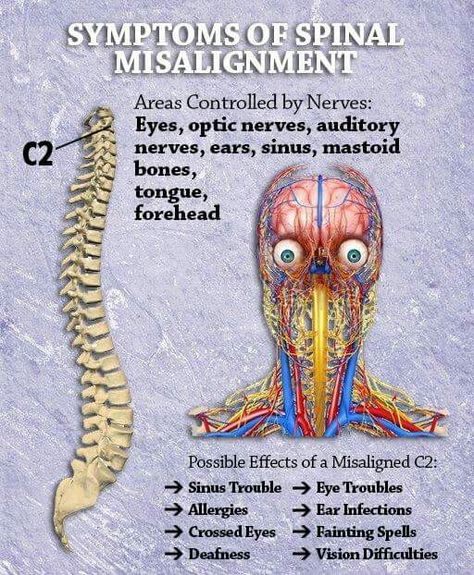 Symptoms of Spinal Misalignment Spinal Misalignment, Nerve Anatomy, Benefits Of Chiropractic Care, Chiropractic Therapy, Crps Awareness, Health Chart, Spinal Nerve, Chiropractic Clinic, Human Body Anatomy