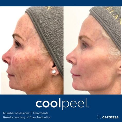 CoolPeel: Charlotte, NC | The Center for Women's Aesthetics Coolpeel Laser, Heavy Sweating, Laser Resurfacing, Skin Tissue, Body Healing, Enlarged Pores, Cosmetic Procedures, Layers Of Skin, Improve Skin Texture