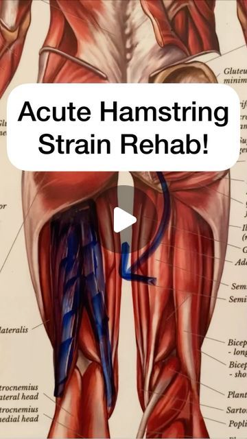 Dr. Michael Giardina, DPT, OCS on Instagram: "🚨ACUTE HAMSTRING STRAIN REHAB🚨

💥 Try these 3 movements in the acute phase of a hamstring strain:

1️⃣ Nerve Flossing - priming nerve movement as well as hamstring passive motion.
2️⃣ Heel Slides - maintain heel against table. Use strap assist if active motion alone painful.
3️⃣ Hamstring Isometric - press into physioball maintaining an isometric hold. Hold 10 seconds each.

🟩 With an acute hamstring strain, our first priority is to protect👮‍♀️(off load the structure using a cane, walking stick, or crutches) and allowing healing. This is to restore pain-free motion.

🟧 Recent evidence has shown that rest within the first 24-48 hrs⏰increases stiffness and causes weakness in affected areas and adjacent ones. Once motion is pain-free👍🏻, th Nerve Flossing, Crutches, Walking Stick, 10 Seconds, Pain Free, Nerve, Slides, Motion